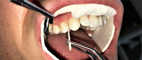Mouth with probes