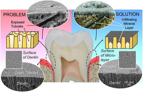 Guided by a peptide derived from the protein used to develop teeth, the remineralization process covers sensitive tissue with new mineral microlayers. Credit: ACS Publications. 