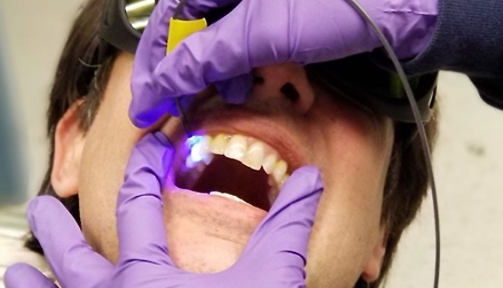 A prototype scanner developed by University of Washington researchers can read acidity levels on teeth painted with fluorescent dye to find where they are at highest risk of dental decay.