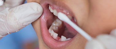 gloved hands apply varnish to child's teeth