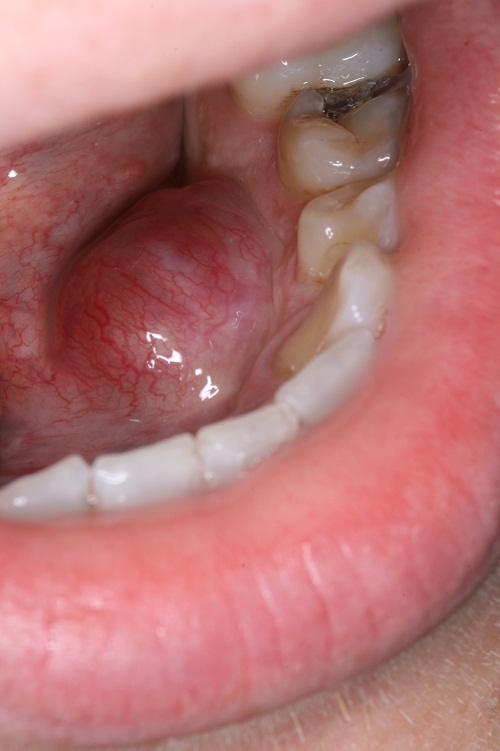 floor-of-mouth-swelling-siswanto-floor