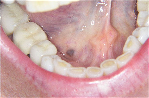 malignant melanoma mouth