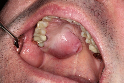 retromolar trigone swollen