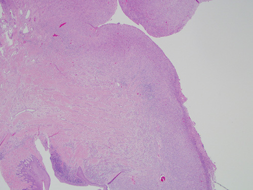 Figure 13 /></noscript></p>
<p><b>Figure 3.</b> Low power (x40) the H & E histology reveals a large mass of ulcerated granulation tissue composed of proliferating fibroblasts, proliferating endothelial cells and small blood vessels of variable shapes and sizes.</p>
<p><img decoding=