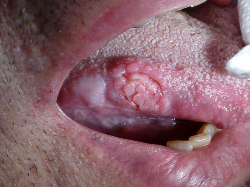 Papilloma of mouth Papilloma mouth cancer