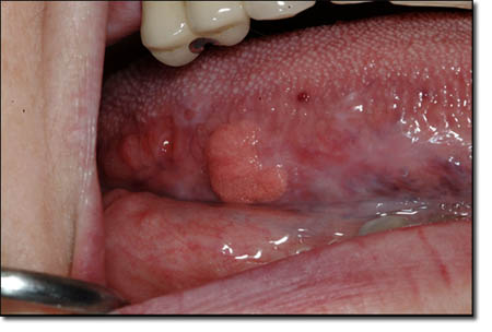 papillary lesion ventral tongue)