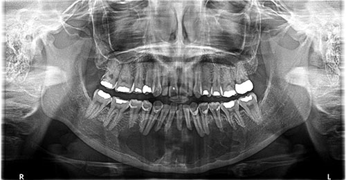 glandular odontogenic cyst