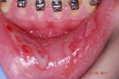 viral stomatitis adults