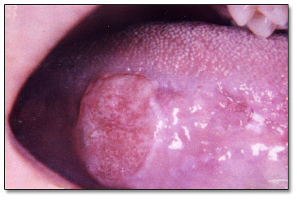 View of lateral border of the tongue.